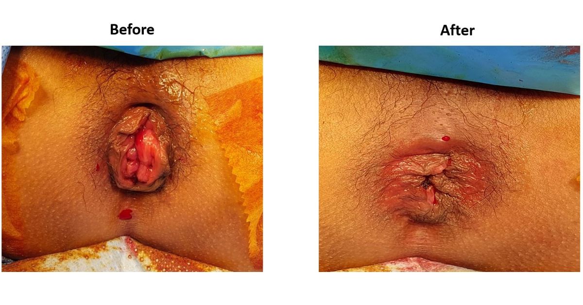 Laser Piles Surgery Before After