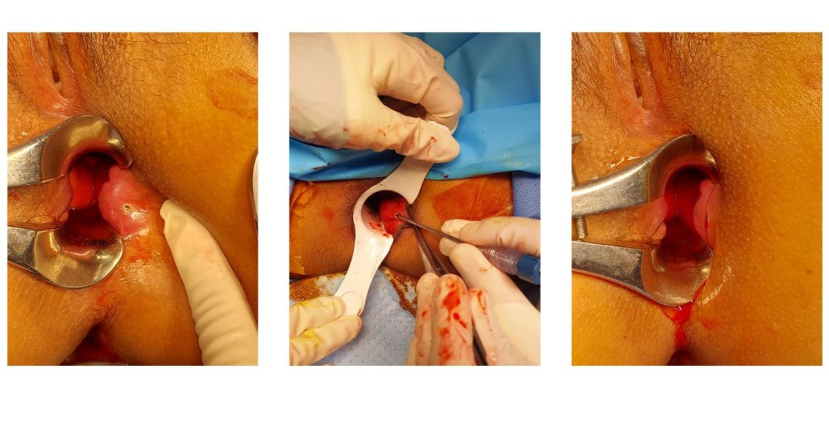 Laser Piles Surgery-Procedure