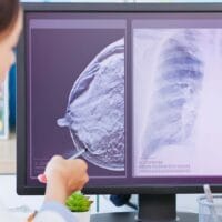 Doctor discussing breast cancer treatment options with patient