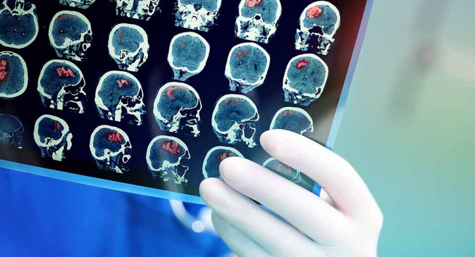 Brain cancer or Brain Tumor Diagnosis in Singapore