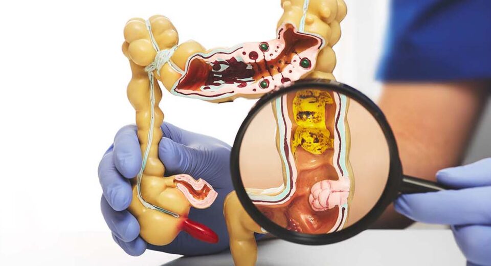 What are colorectal cancer causes