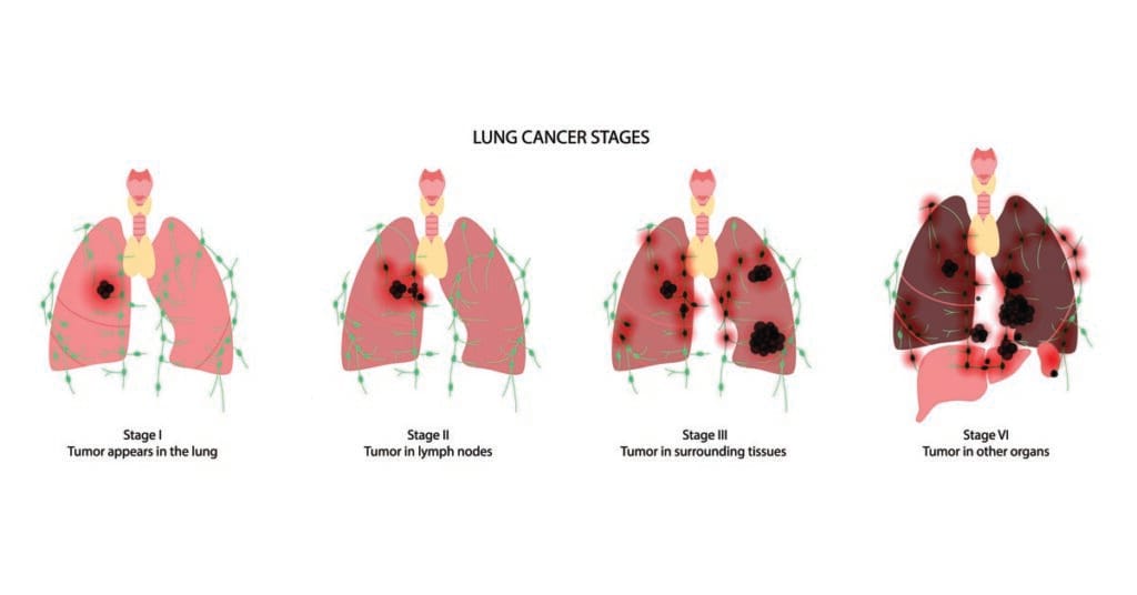 Stages Of Lung Cancer - Health365