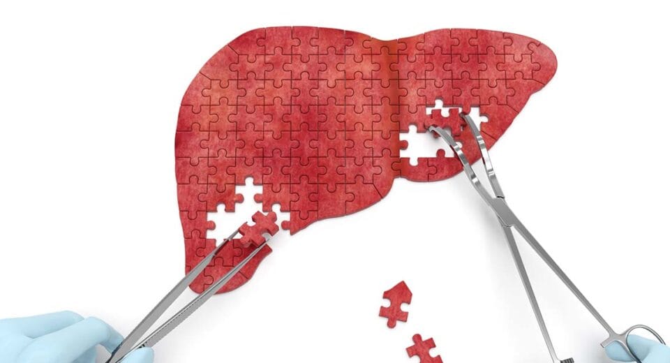 Liver cancer treatment in Singapore