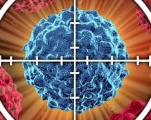 EBRT prostate cancer treatment in Singapore