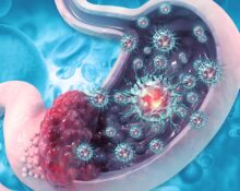 Understanding gastric cancer and its treatment
