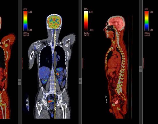 What is a PET Scan