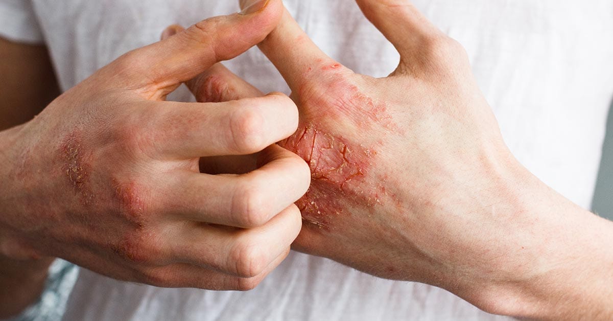 Eczema Treatments In Singapore