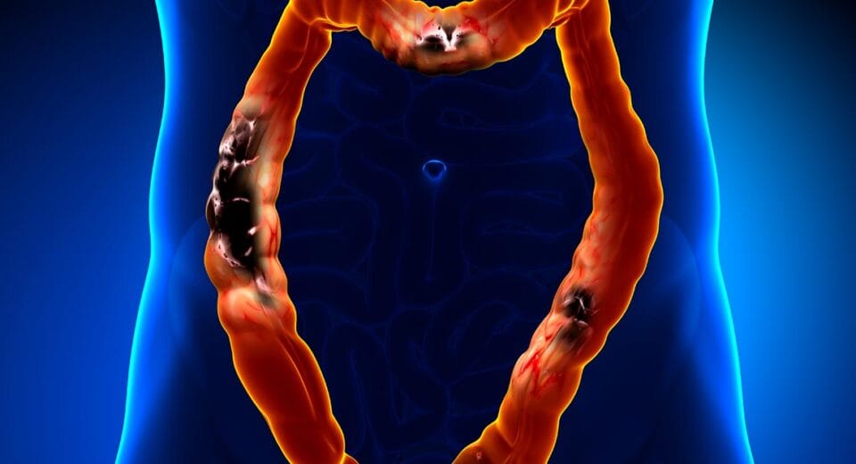 Colorectal Cancer