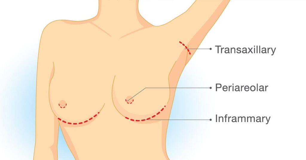 breast implant incision