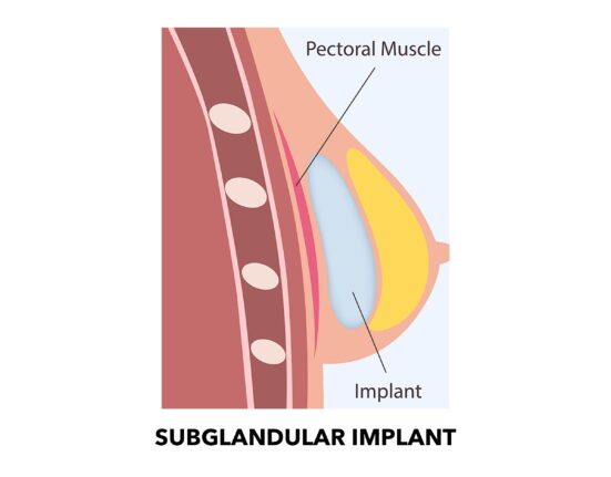 subglandular implant