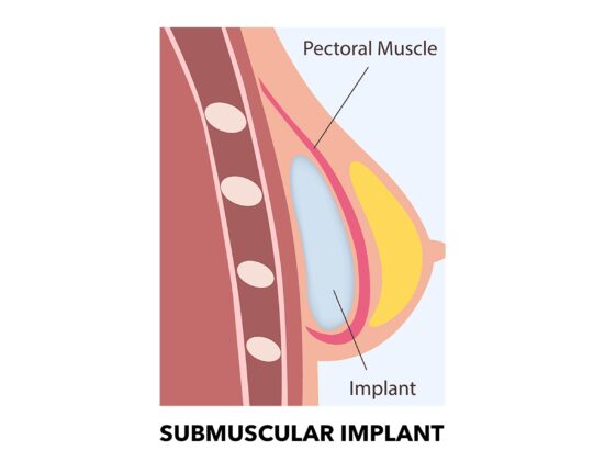 submuscular implant