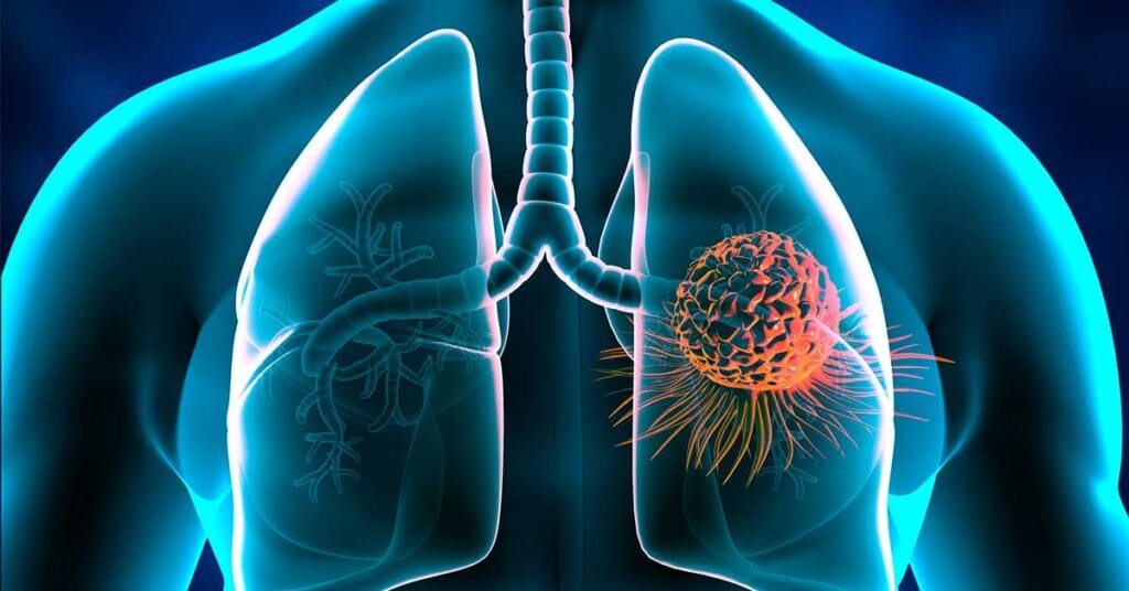 Lung Cancer