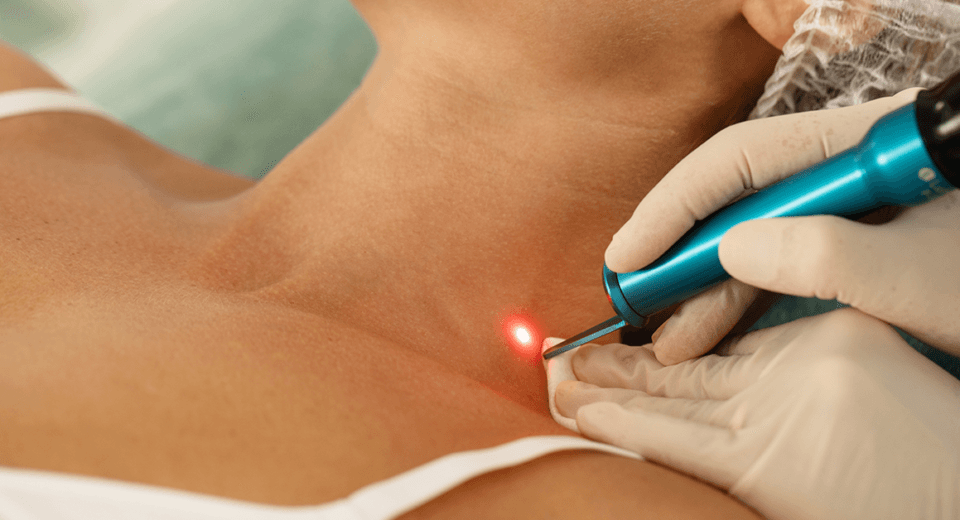 Laser Treatment For Pigmentation