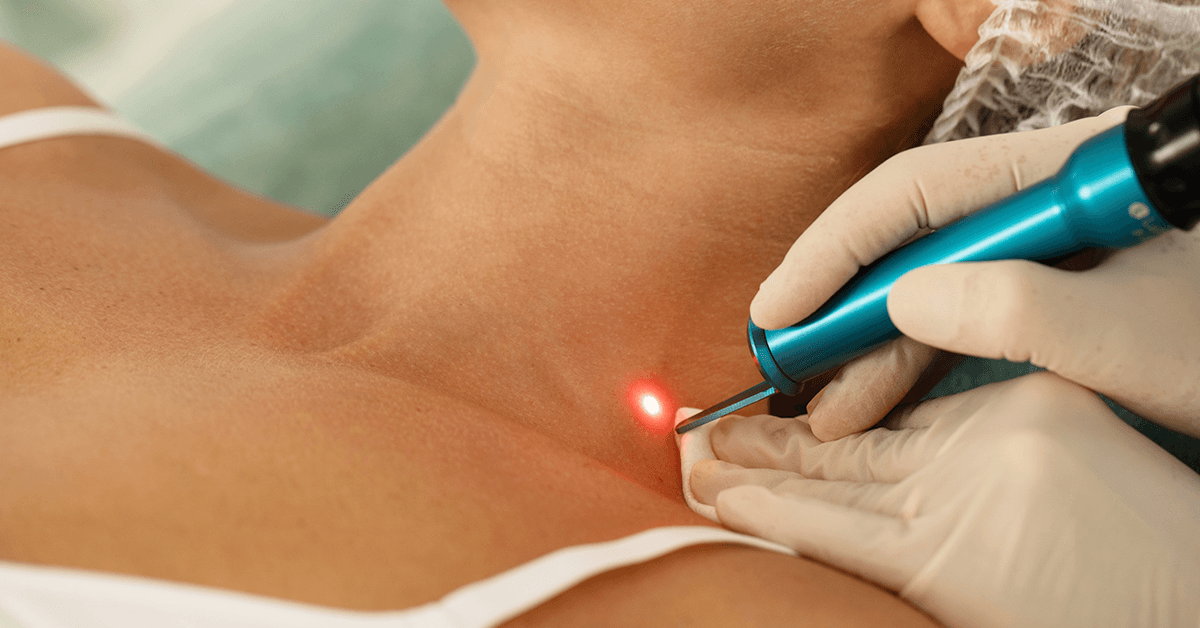 Laser Treatment For Pigmentation