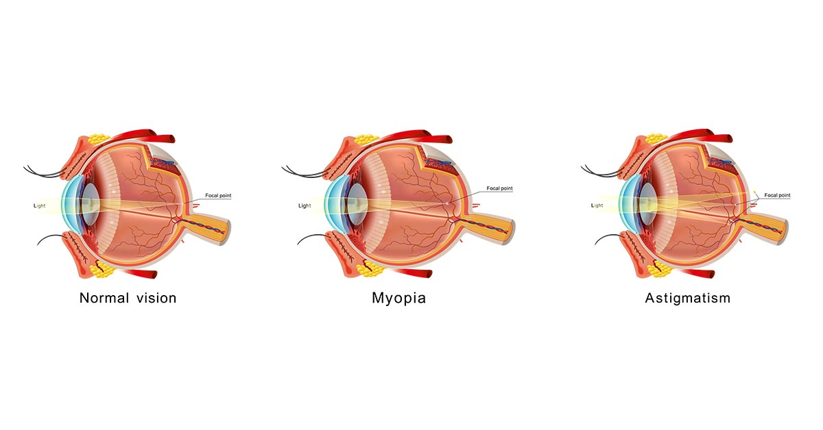 Astigmatism Vs Myopia Illustration