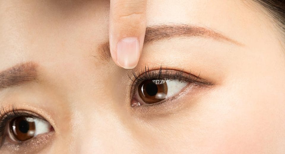 Double Eyelid Surgery