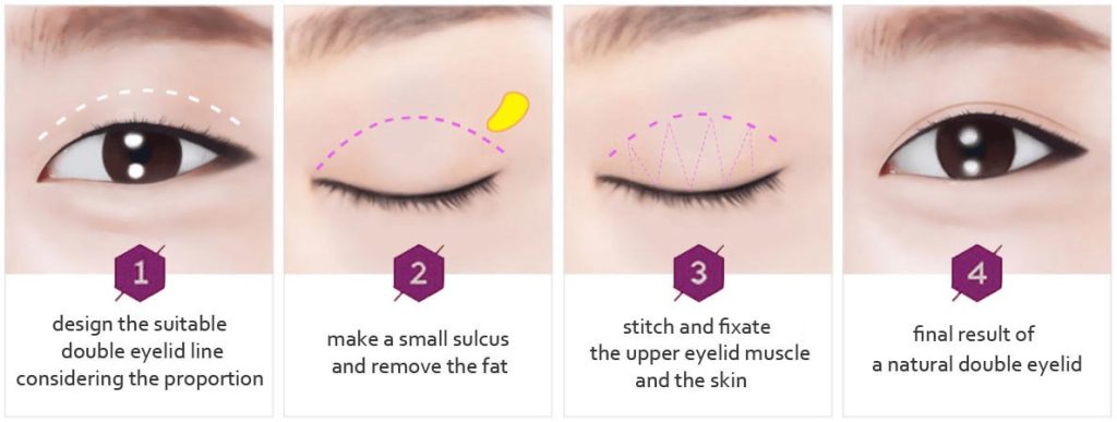 Double Eyelid Surgery Non-Incisional