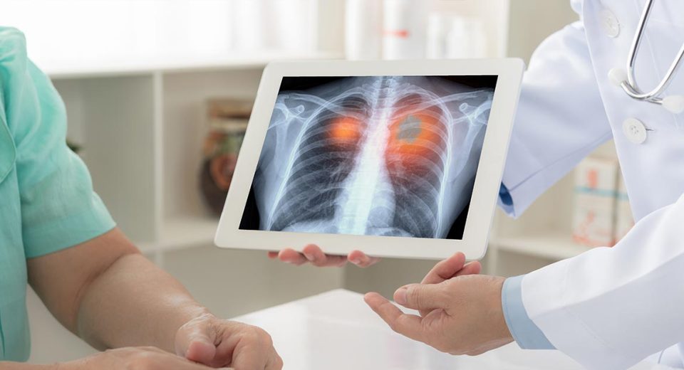 Lung Cancer Screening Singapore