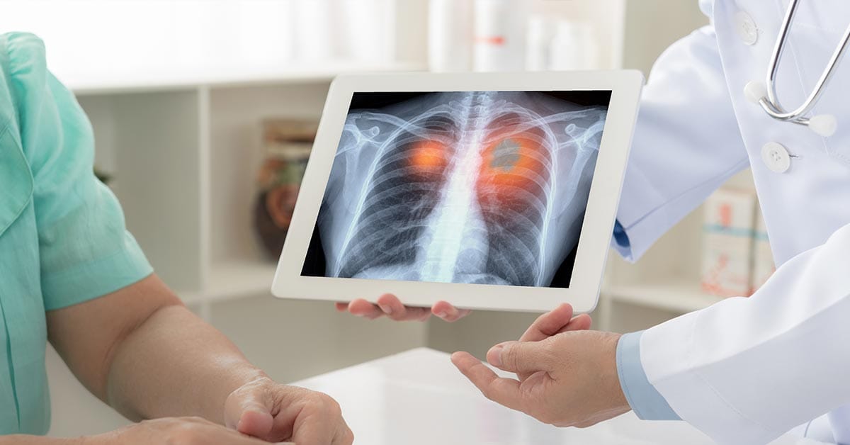 Lung Cancer Screening Singapore
