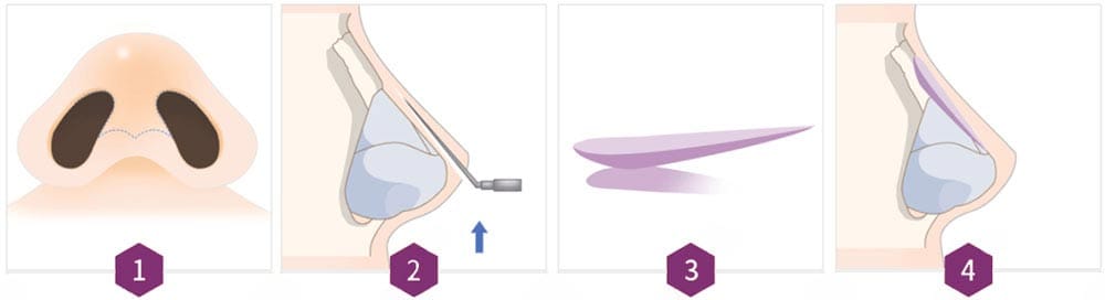 Nose Bridge Implant