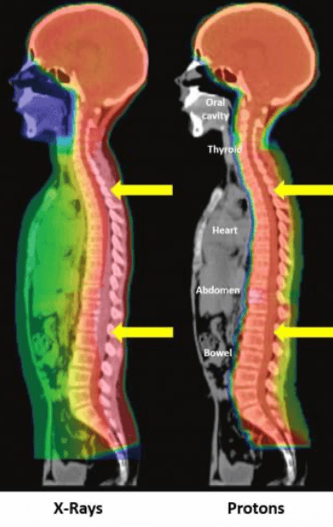 Proton Therapy Benefit