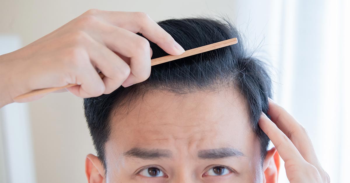 Hair Loss Treatment Singapore