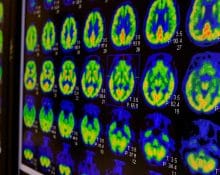 PET Scan Alzheimer's Disease