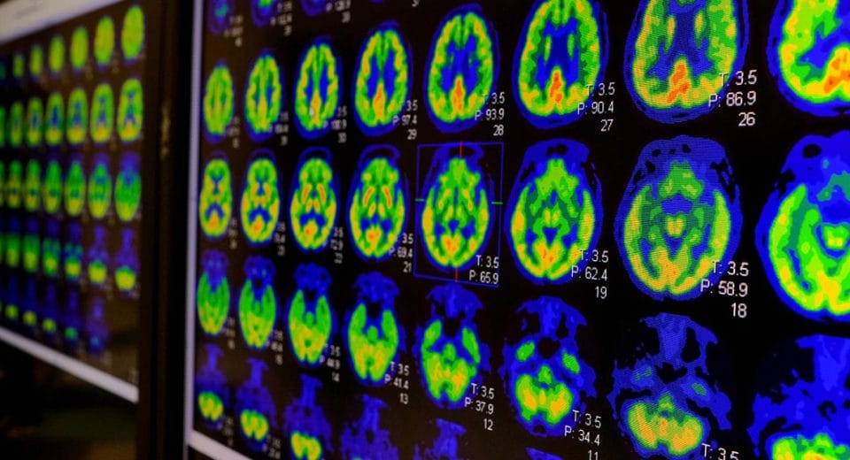 PET Scan Alzheimer's Disease