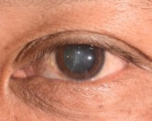 Cataract In Singapore, Cataract Surgery In Singapore