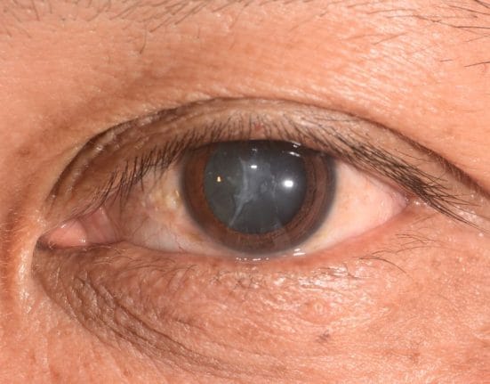 Cataract In Singapore, Cataract Surgery In Singapore