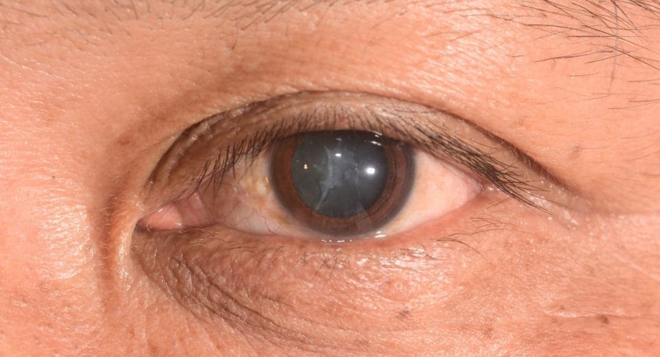 Cataract In Singapore, Cataract Surgery In Singapore