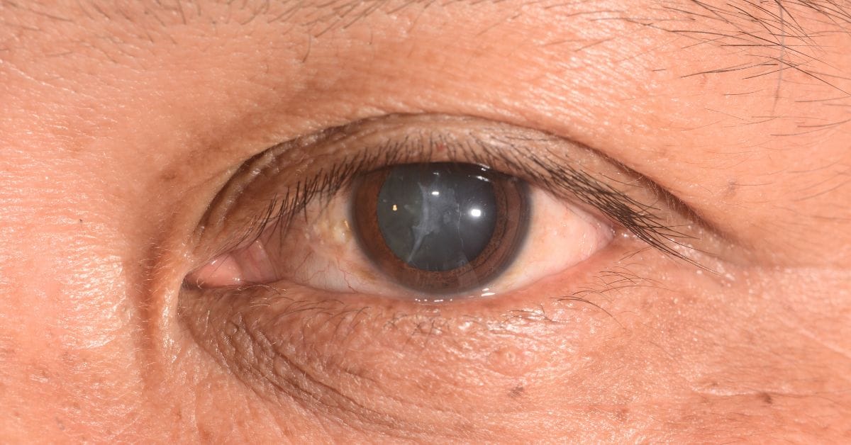 Cataract In Singapore, Cataract Surgery In Singapore