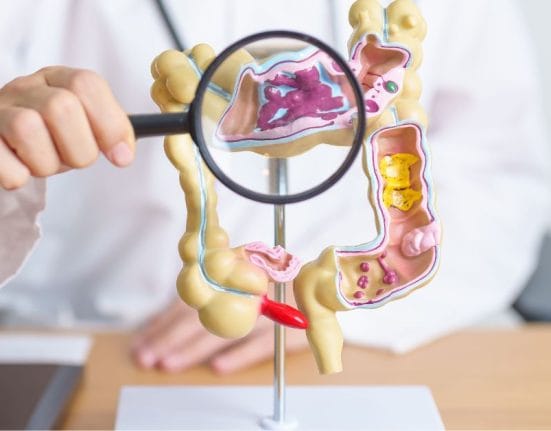 Colorectal Cancer In Singapore; colorectal cancer treatment