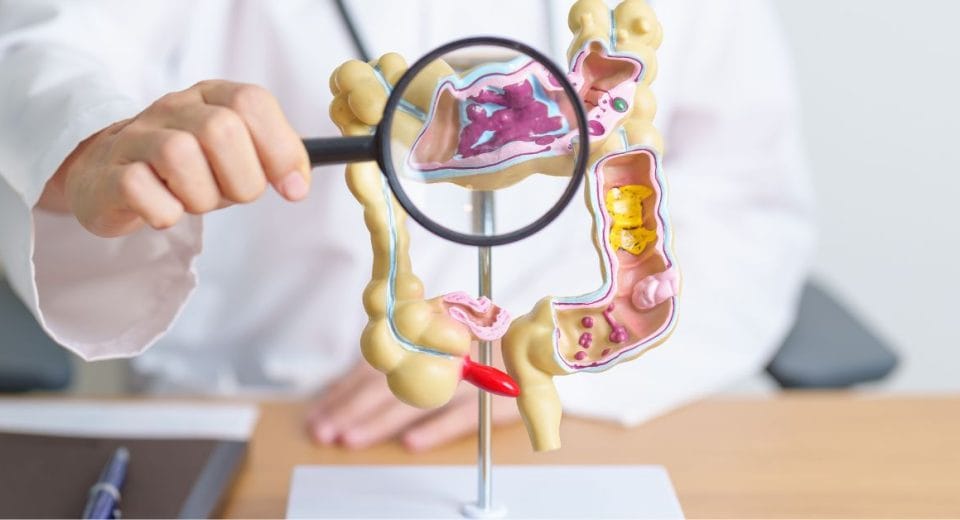 Colorectal Cancer In Singapore; colorectal cancer treatment