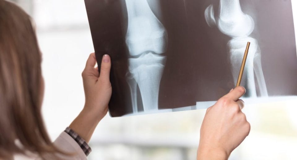 Knee Replacement Surgery Singapore