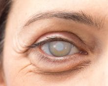 Cataract Surgery Singapore