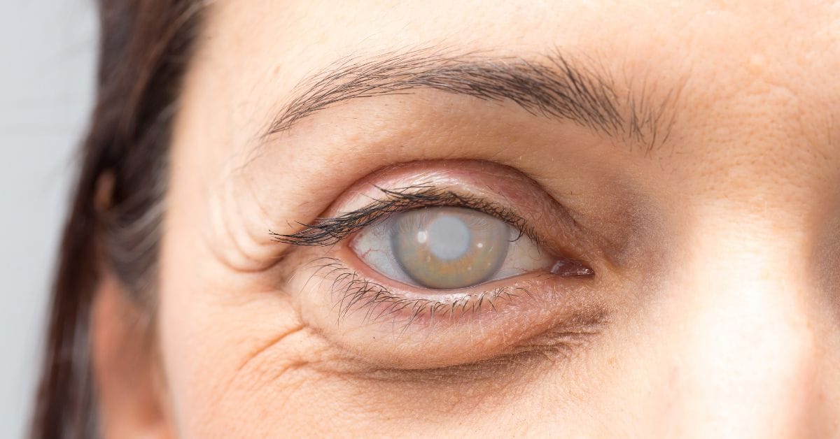Cataract Surgery Singapore