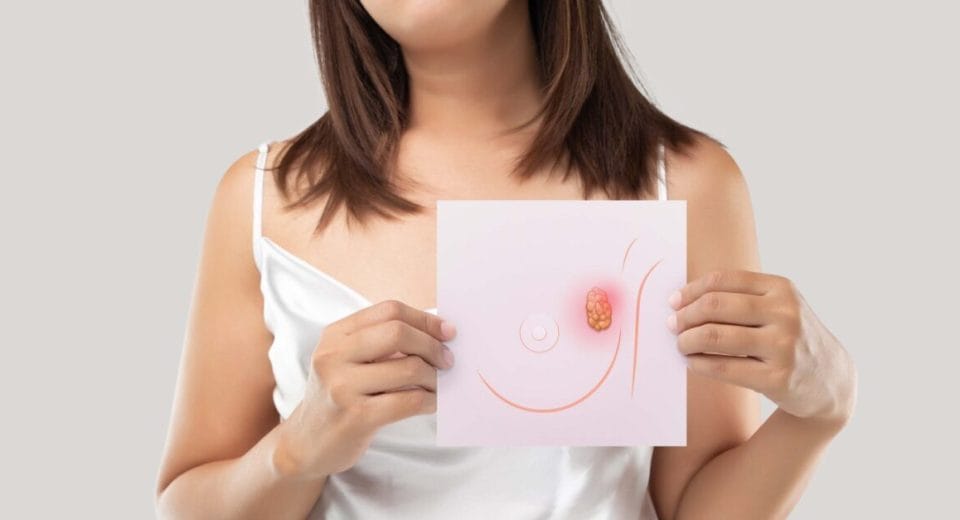 Breast Cancer Surgery
