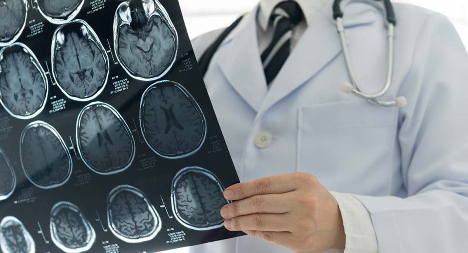 Stroke screening in Singapore