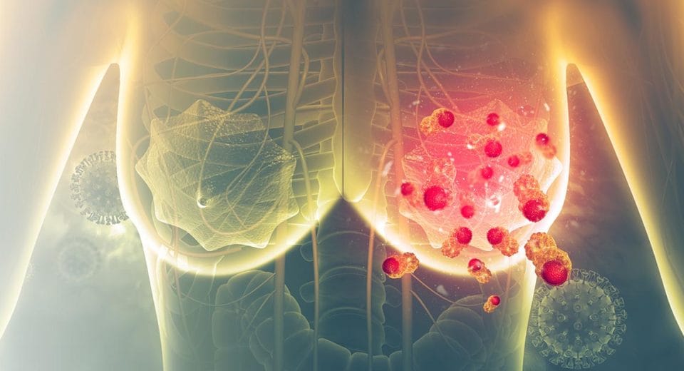 Symptoms Of Breast Cancer Singapore