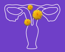 uterine fibroids image women's health gynecological conditions