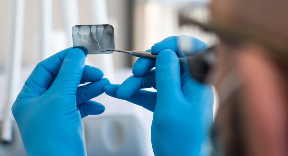 root canal treatment