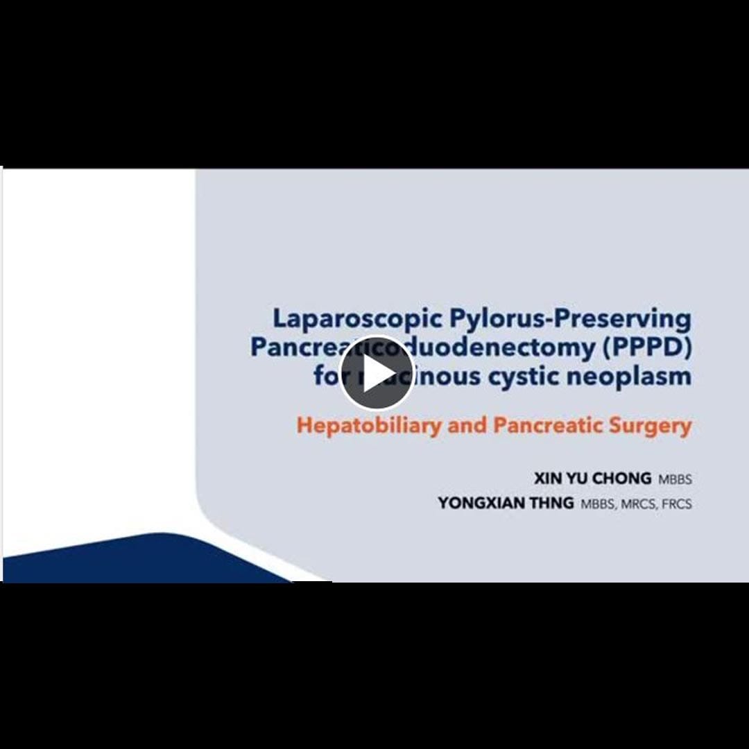 Dr Thng Yongxian Social Post on laparoscopic pancreaticoduodenectomy
