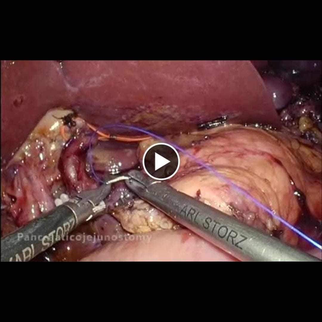 Dr Thng Yongxian Social Post on Laparoscopic pancreaticojejunostomy