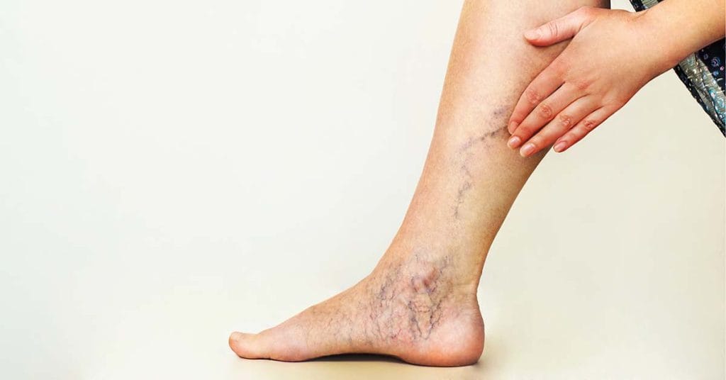 Varicose Veins? What You Need To Know - Health365