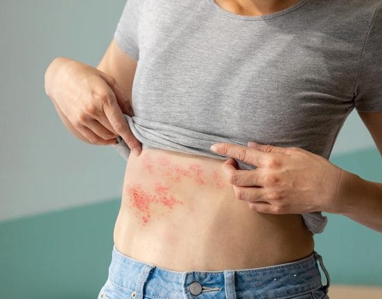 Prevent Shingles Painful Condition; Shingles vaccine singapore