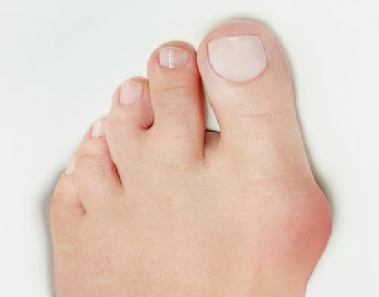 bunion surgery