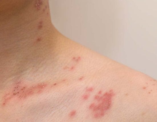 Vaccination for Shingles