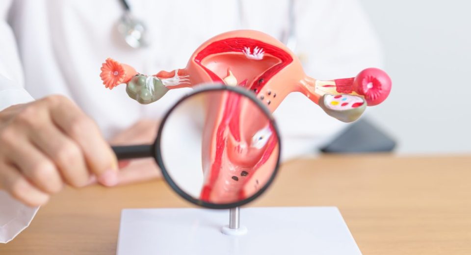aggressive ovarian cancer​