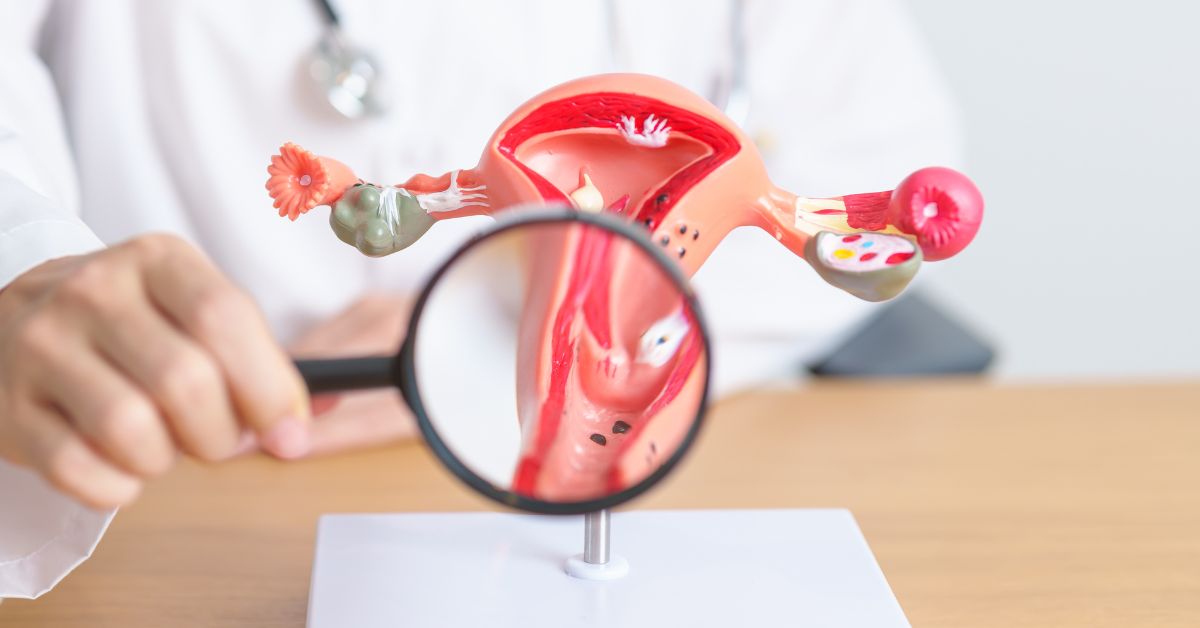 aggressive ovarian cancer​